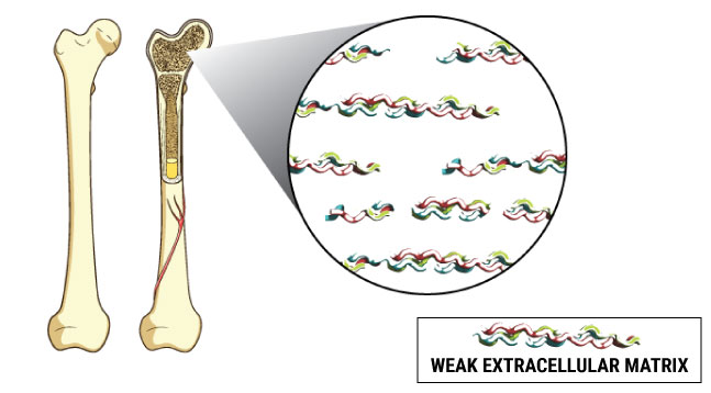 diagram showing weak extracellular matrix inside bone