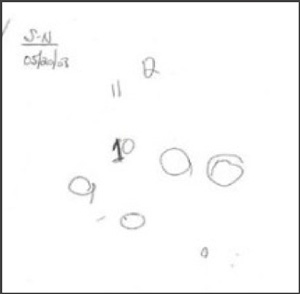 Drawing of a clock by an Alzheimer patient before treatment