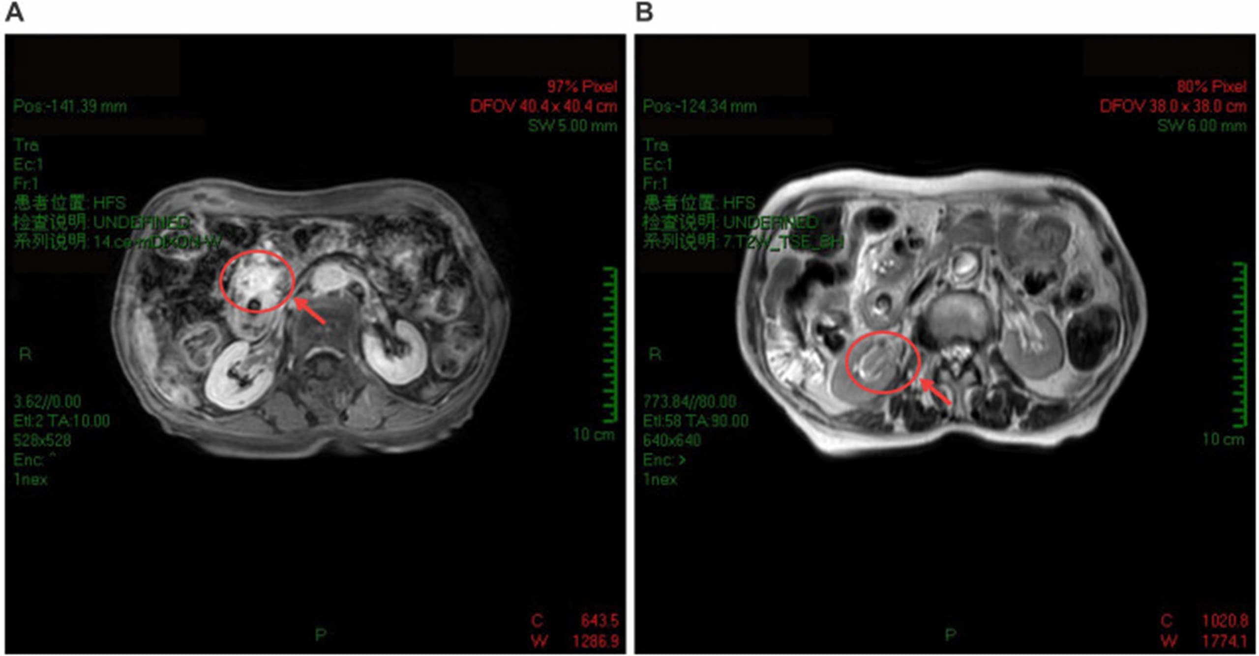 scan of cancer in patient's body