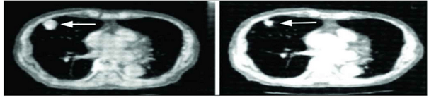 scan of tumor