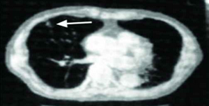 scan of tumor growing smaller