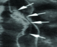 scan of tumor before