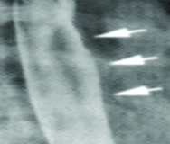scan of tumor after