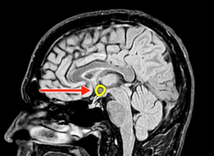 brain scan highlighting the amygdala