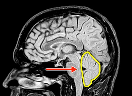 brain scan highlighting the cerebellum