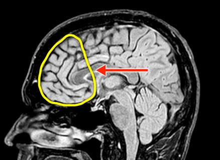 brain scan highlighting the prefrontal cortex