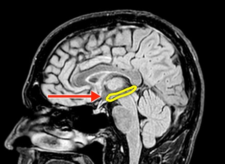 brain scan highlighting the hippocampus