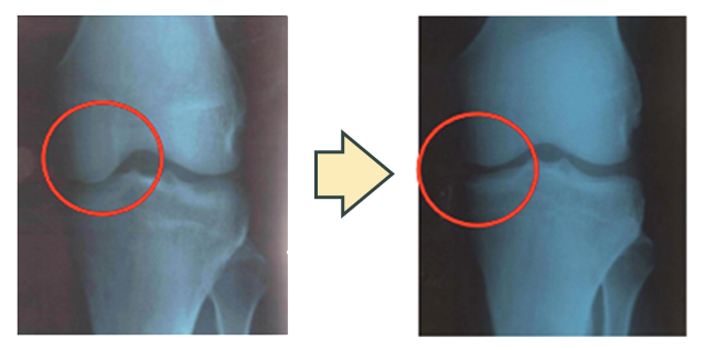 two xrays of knees with red circles showing degraded cartilage